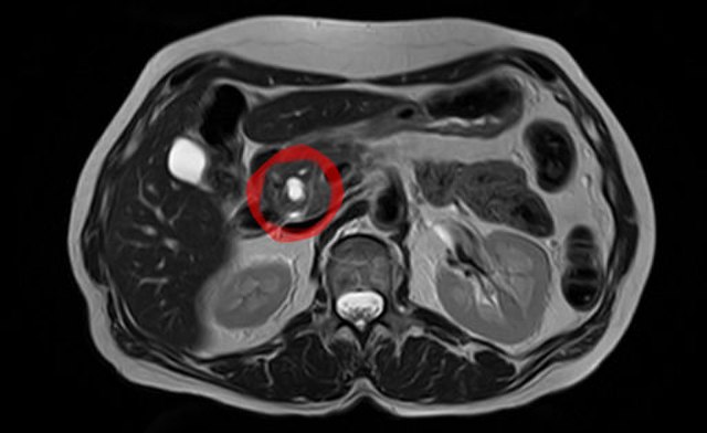Imagem de ressonância magnética abdominal com destaque em vermelho para uma lesão no pâncreas, sugerindo alteração compatível com IPMN.