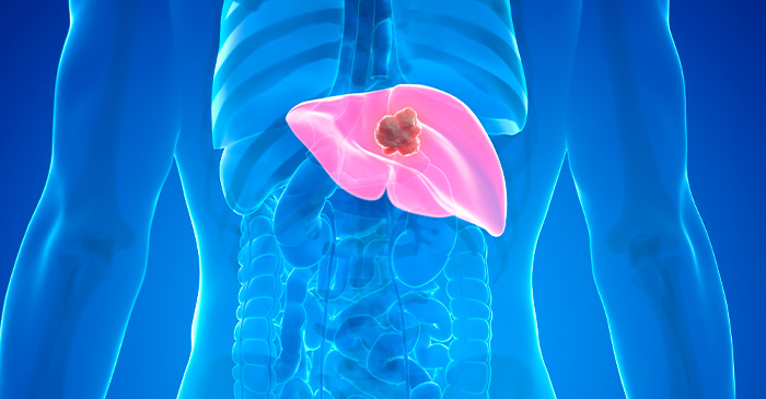 Ilustração médica do corpo humano com destaque para o fígado em rosa, evidenciando a presença de um cisto hepático em tom mais escuro.